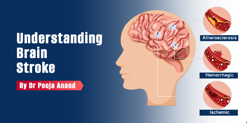understanding-brain-stroke-by-dr-pooja-anand
